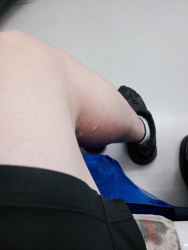 모기에 물린다리